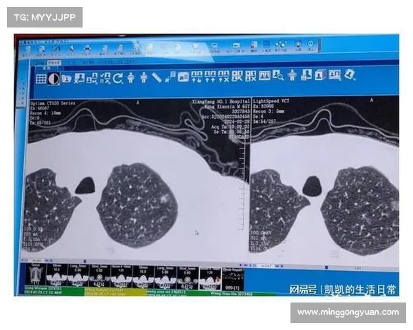 放射物辐射后的肺结节治疗方法